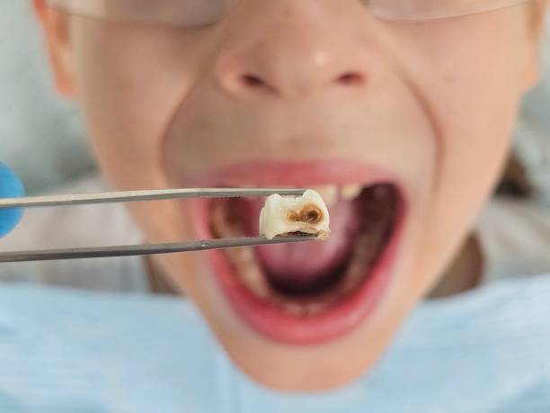 Best Emergency Tooth Extraction in Coquille, OR