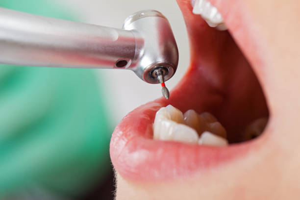 Best Emergency Root Canal Treatment in Coquille, OR